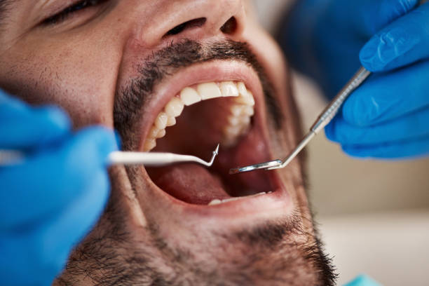 Best Emergency Treatment for Dental Infections or Abscesses in Lake Lakengren, OH