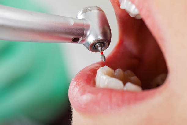 Best Emergency Dental Care for Broken or Chipped Teeth in Lake Lakengren, OH